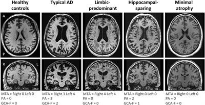 Subtypes of Alzheimer's Disease Display Distinct Network Abnormalities Extending Beyond Their Pattern of Brain Atrophy